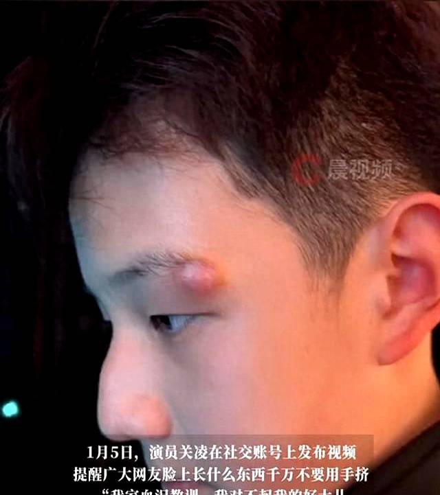 痘”导致儿子做手术脸上缝了4针MG不朽情缘演员关凌用针挑开“(图2)